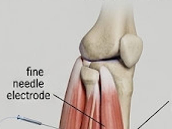 Illustration of a lower leg with a fine needle electrode positioned in the tibialis anterior muscle