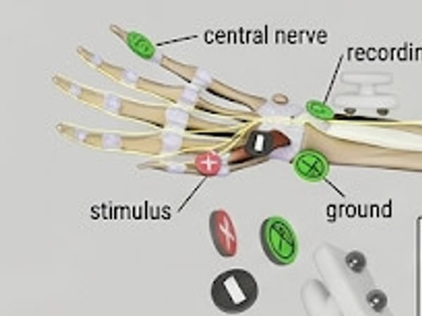 Illustration of a hand and forearm with surface electrodes placed over the nerve for a nerve conduction study