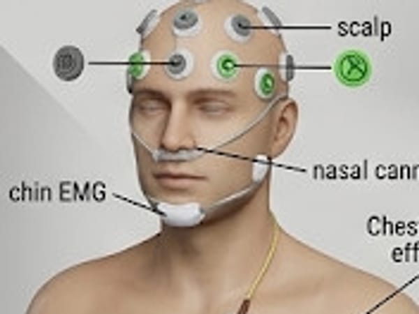 Illustration of a person set up for a sleep study, with scalp sensors, a nasal cannula and a chest sensor