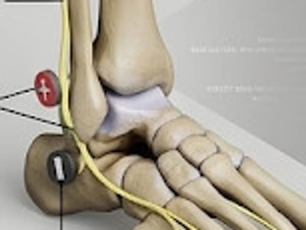 Illustration of an ankle and foot with stimulating electrodes placed over the common peroneal nerve